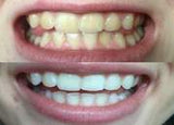 Whitening Toothpaste