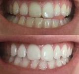 Whitening Toothpaste