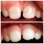 Whitening Toothpaste