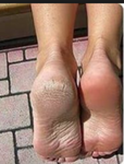 Sole Solution Foot Treatment